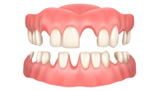 Отсутствует большая часть зубов